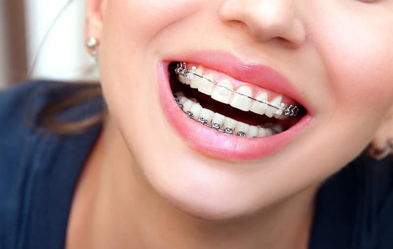 Conozca los beneficios de los brackets estéticos con Clínica Alma